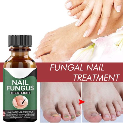 Fast Nail Fungal Treatments Nail Repair Essences Serum Care Treatments Foot Nail Fungus Removal Gel Paronychia Onychomycosis